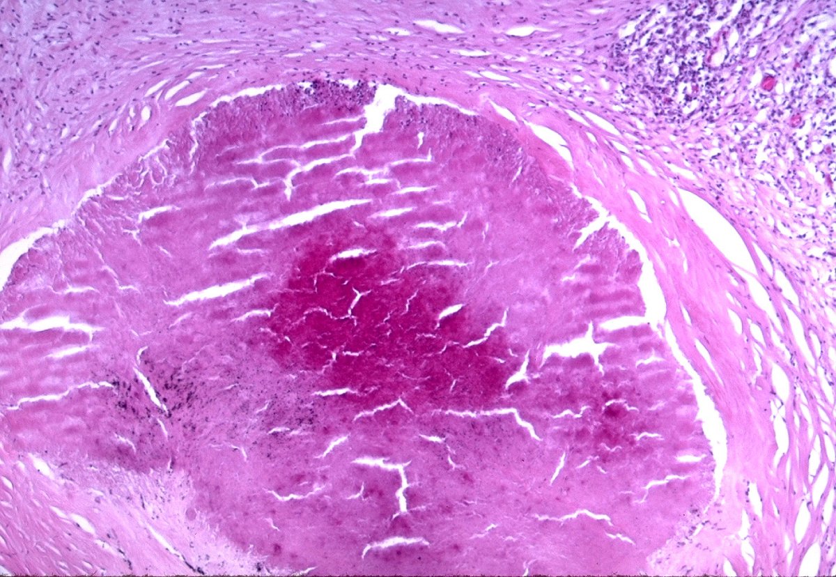 Histoplasma casulatum